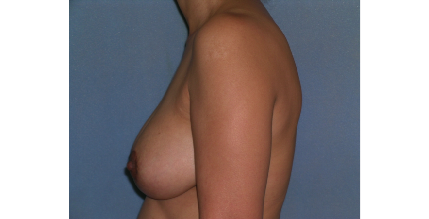 Mastopexy Augmentation Before and After Photos