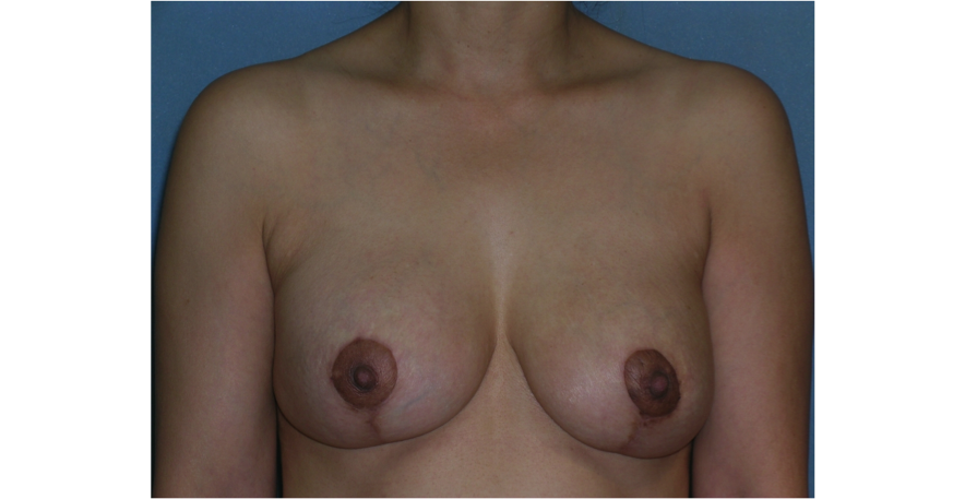 Mastopexy Augmentation Before and After Photos