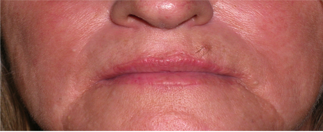 Lip Extension Surgery Before and After Photos | Dr. Balakhani