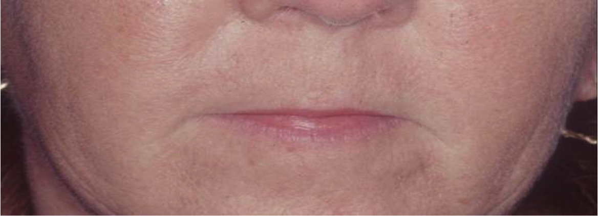 Lip Extension Surgery Before and After Photos | Dr. Balakhani