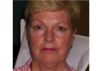 Micropigmentation