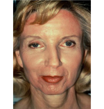 Laser Resurfacing