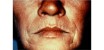 Laser Resurfacing