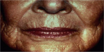 Laser Resurfacing