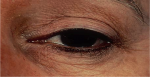 Laser Resurfacing