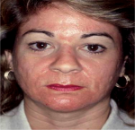Laser Resurfacing