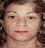 Laser Resurfacing