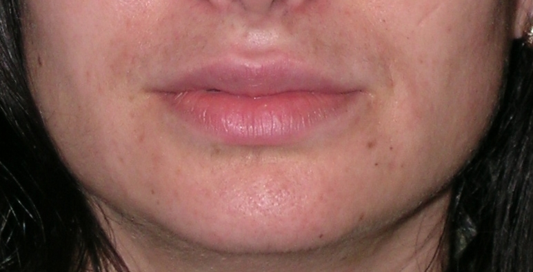 Dermal Fillers Before and After Photos