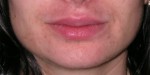 Dermal Fillers
