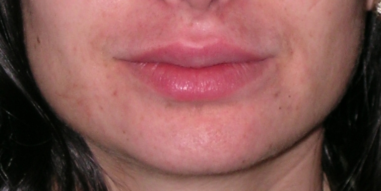 Dermal Fillers Before and After Photos