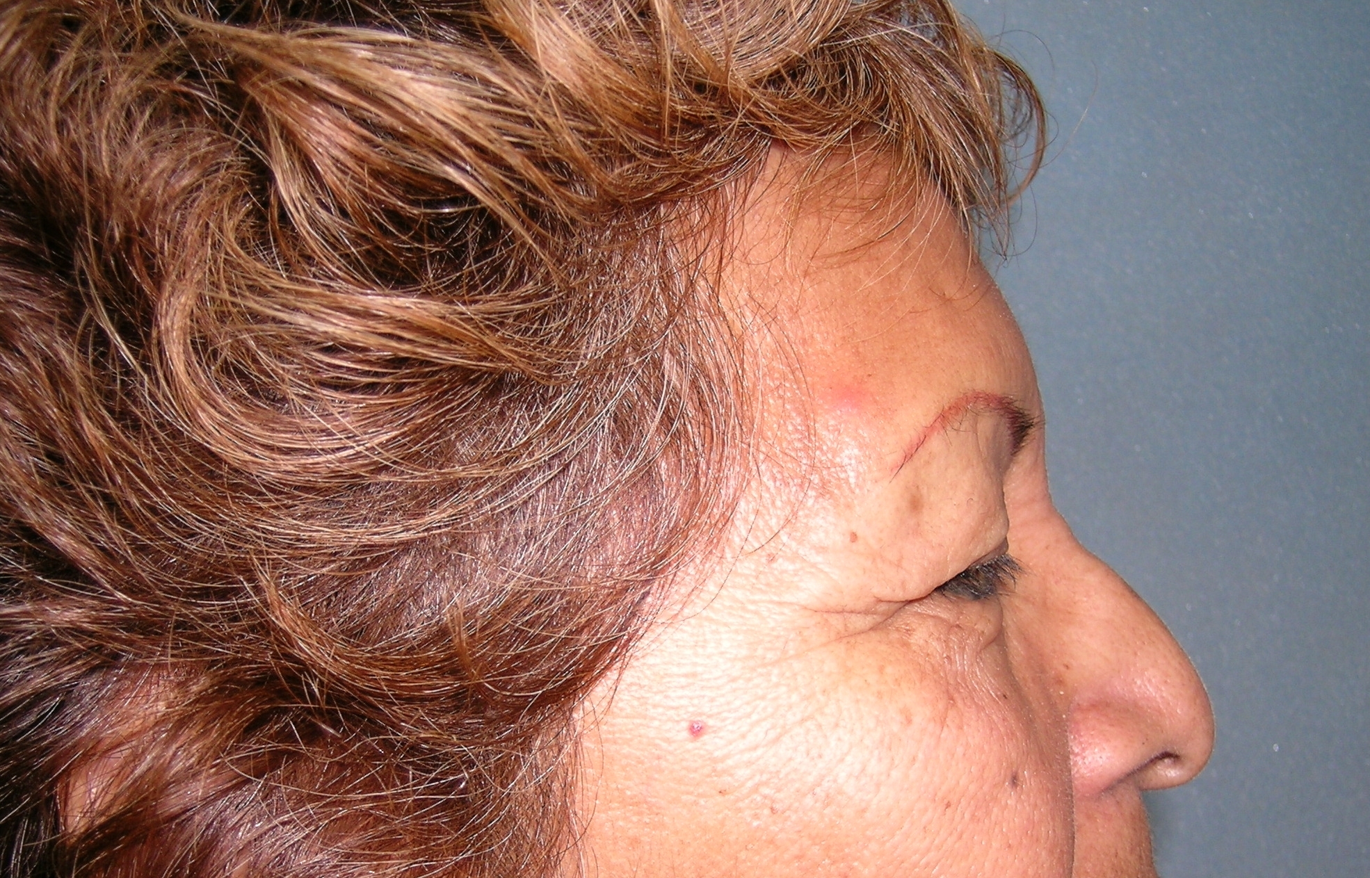 Endoscopic Forehead Lift Before and After Photos