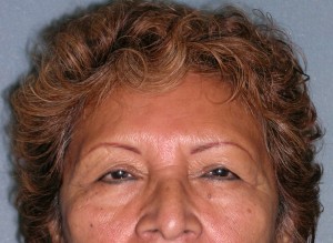 Endoscopic Forehead Lift Case 4340 Before Photo Endoscopic Forehead Lift