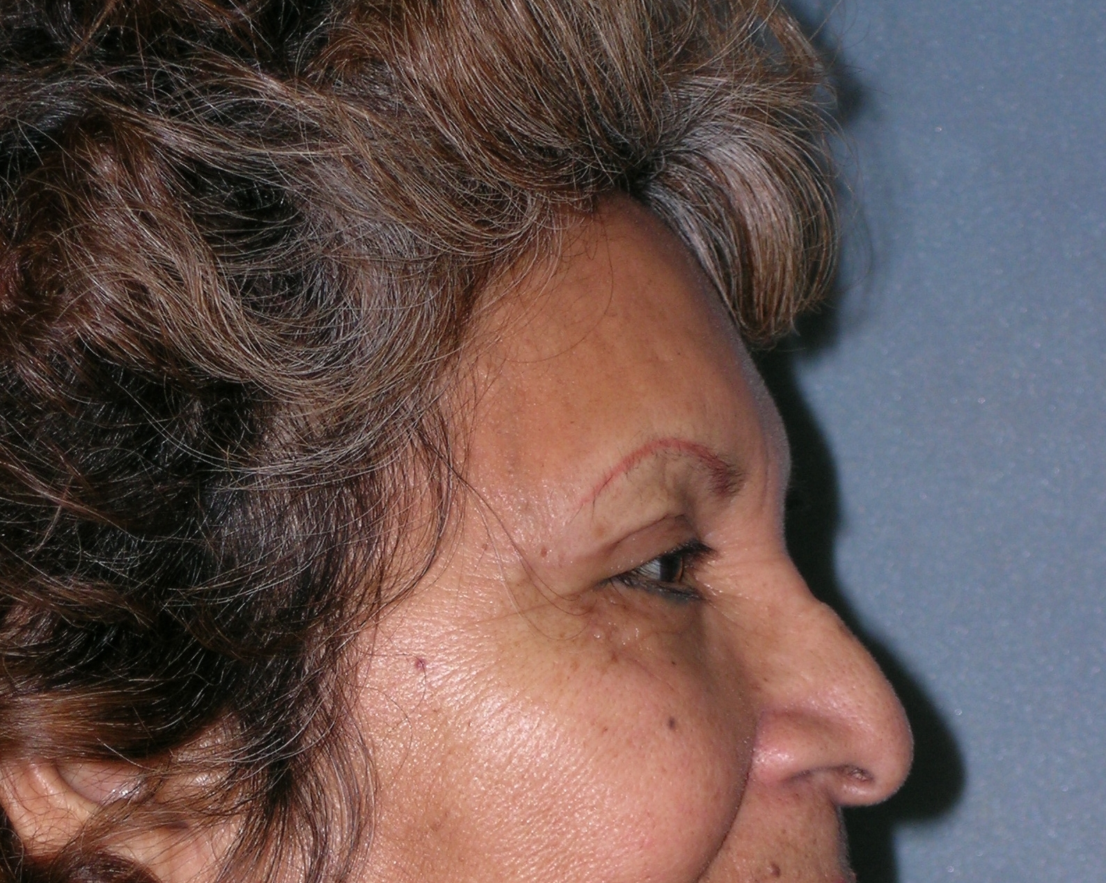 Endoscopic Forehead Lift Before and After Photos