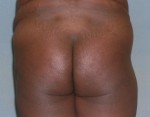 Brazilian Butt Lift