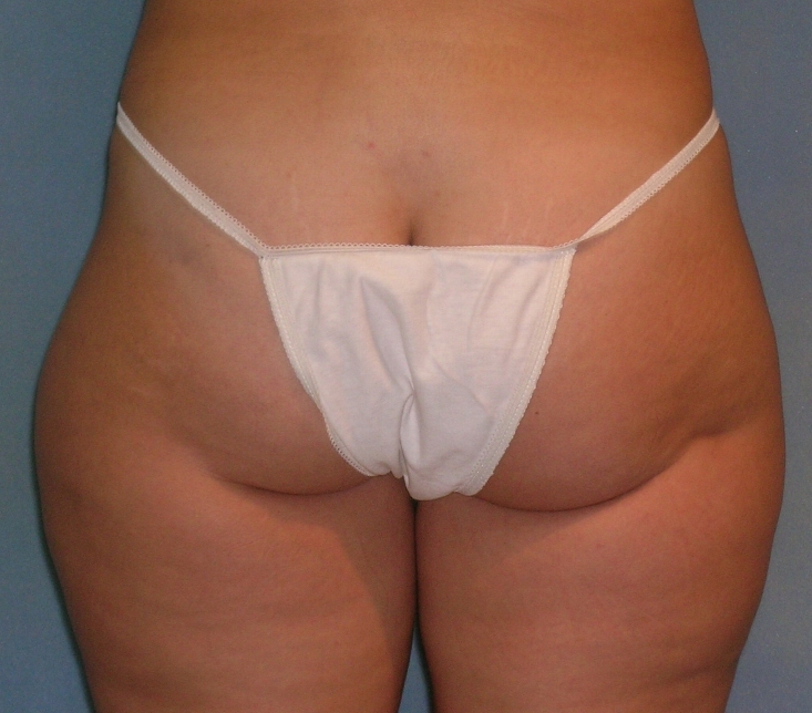 Brazilian Butt Lift Before and After Photos