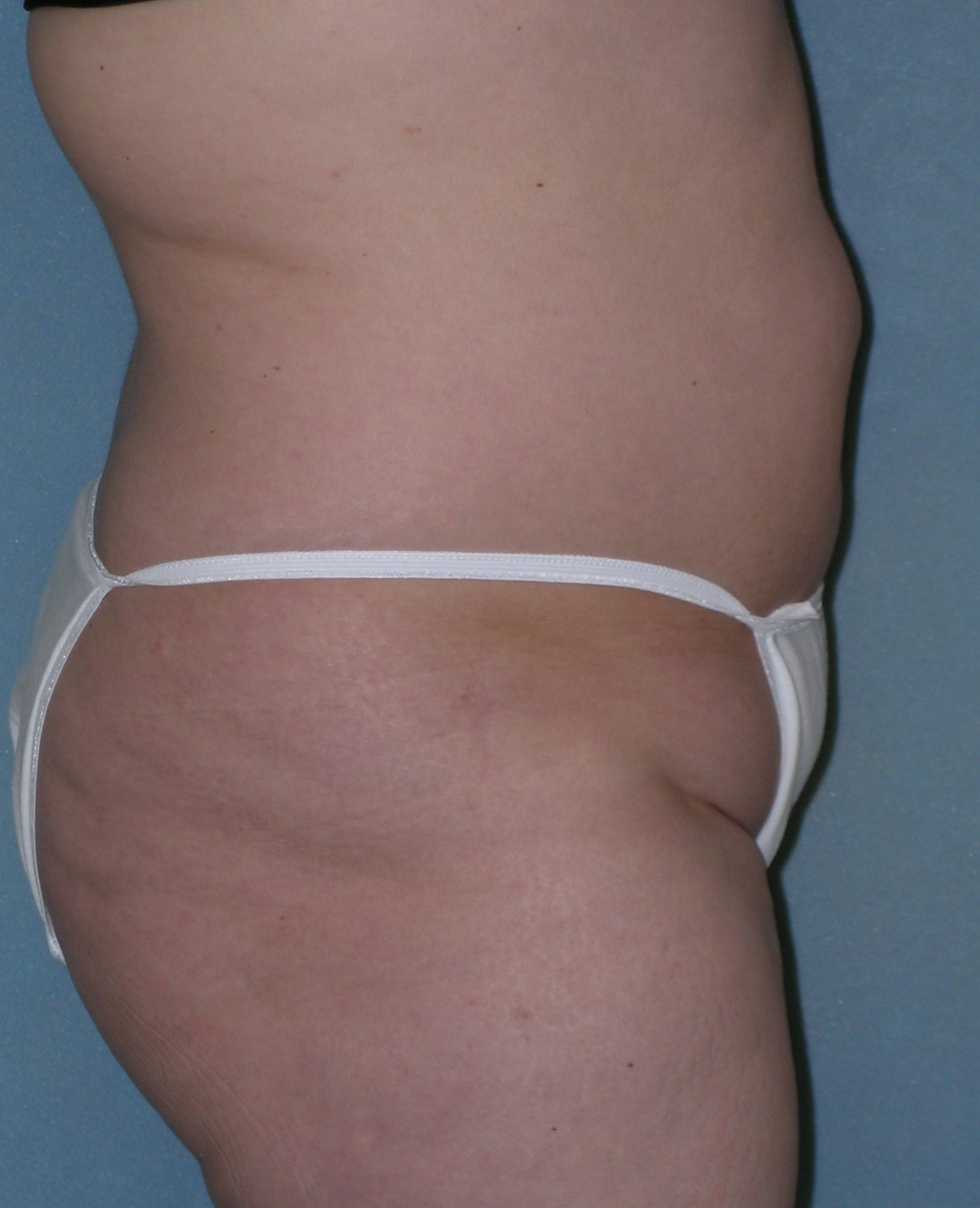 Before After Photos Belt Lipectomy