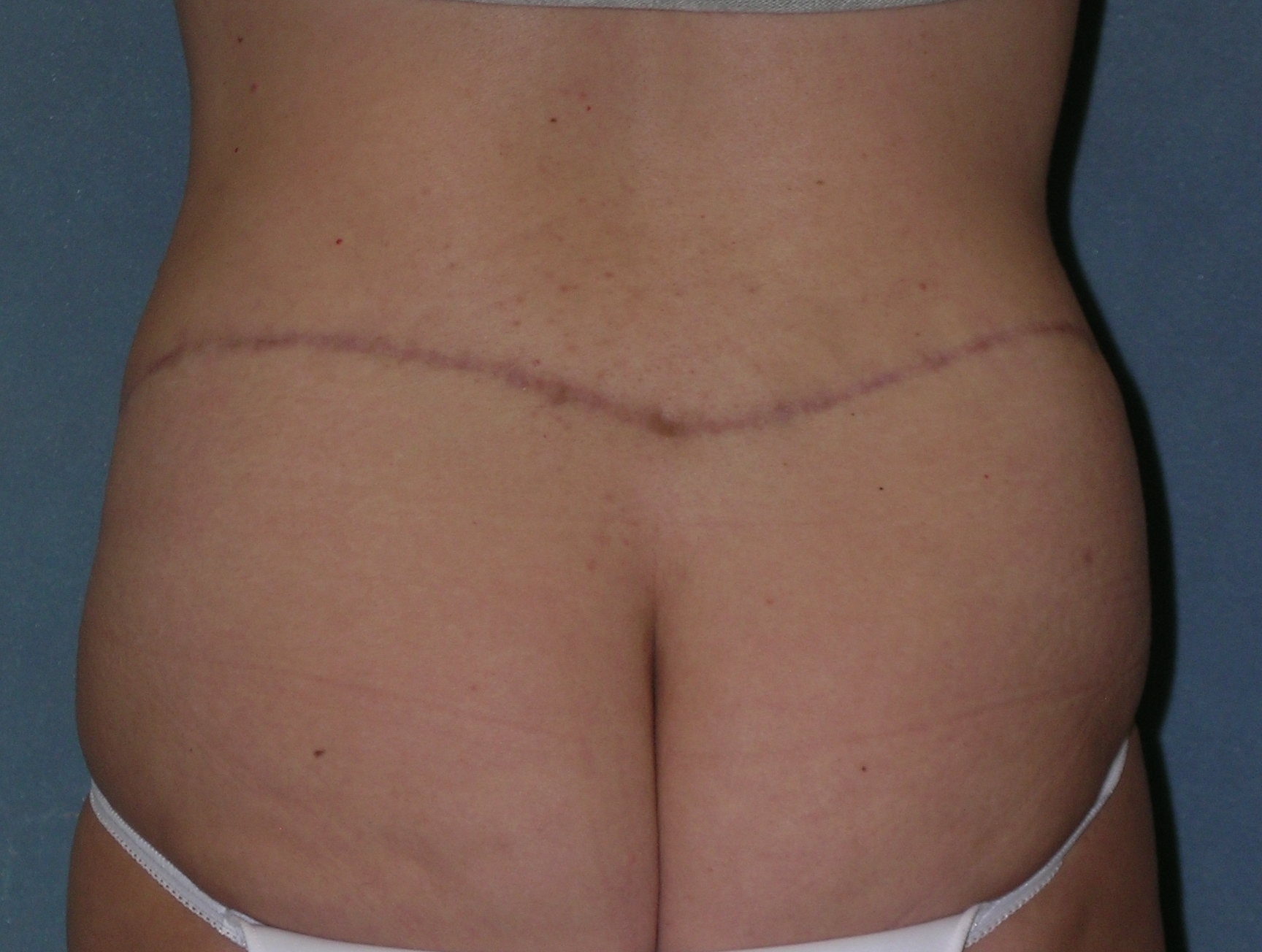 Before After Photos Belt Lipectomy