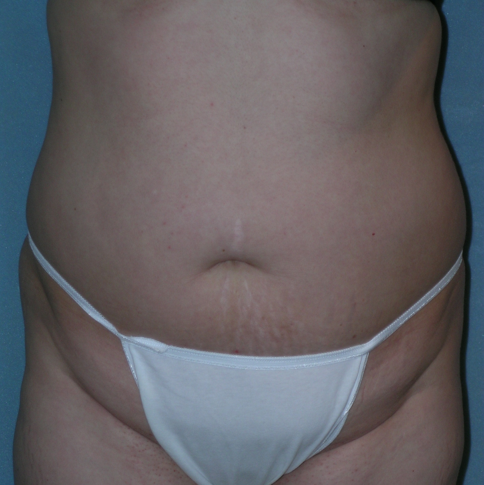 Before After Photos Belt Lipectomy