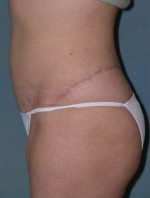 Belt Lipectomy