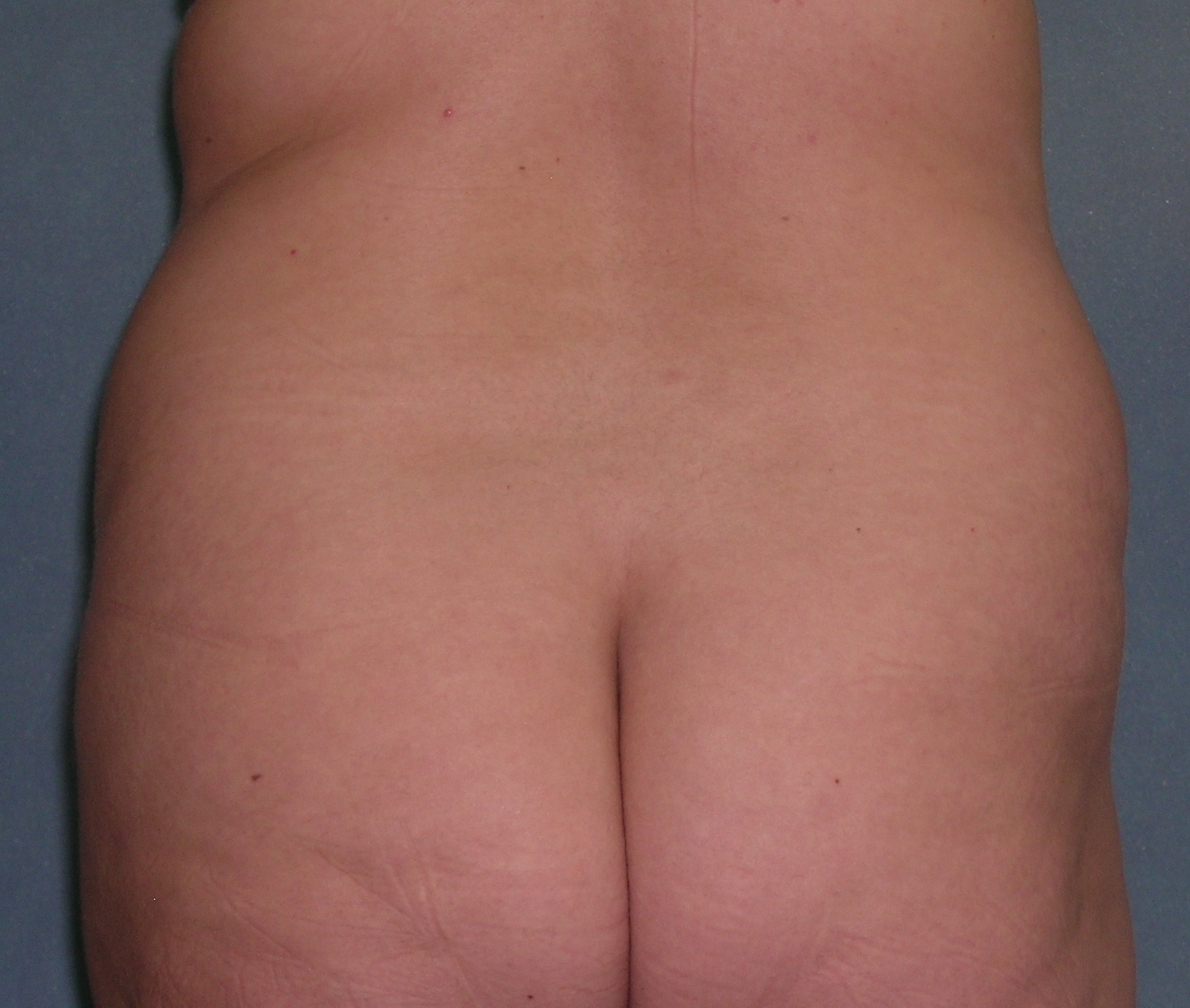 Before After Photos Belt Lipectomy