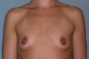 Augmentation Mammoplasty Case 4380 Before Photo Augmentation Mammoplasty
