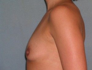 Augmentation Mammoplasty