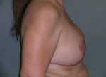 Mastopexy Augmentation