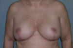 Mastopexy Augmentation