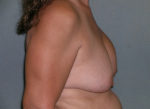 Mastopexy Augmentation