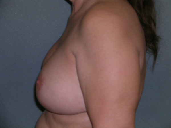 Mastopexy Augmentation Before and After Photos