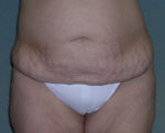 Tummy Tuck