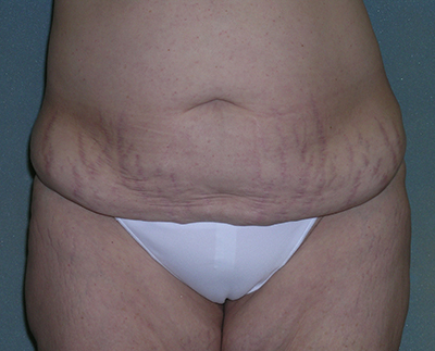 Tummy Tuck Before and After Photos