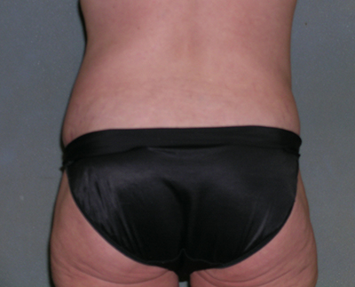 Tummy Tuck Before and After Photos