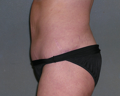 Tummy Tuck Before and After Photos