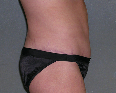 Tummy Tuck Before and After Photos