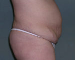 Tummy Tuck