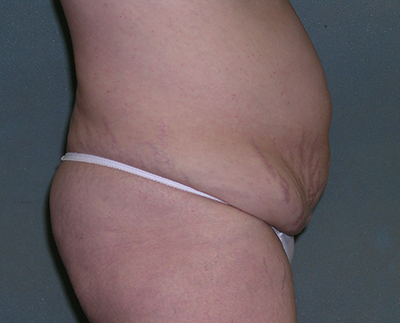 Tummy Tuck Before and After Photos