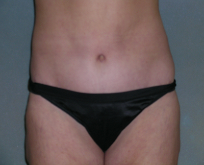 Tummy Tuck Before and After Photos