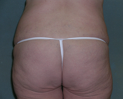 Tummy Tuck Before and After Photos