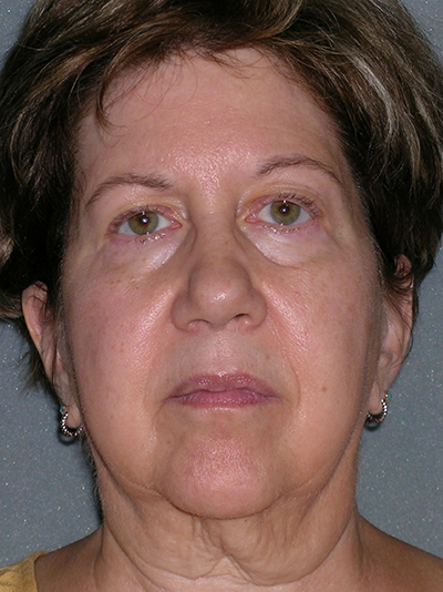 Facelift Before and After Photos