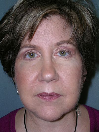 Facelift Before and After Photos