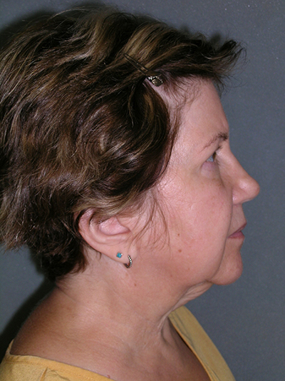 Facelift Before and After Photos