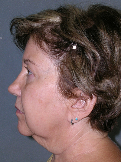 Facelift Before and After Photos