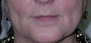 Dermal Fillers Before and After Photos