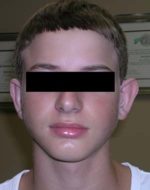 Otoplasty