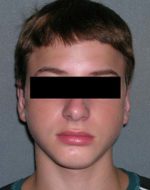 Otoplasty