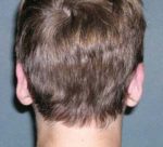 Otoplasty