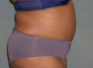 Tummy Tuck Before and After Photos