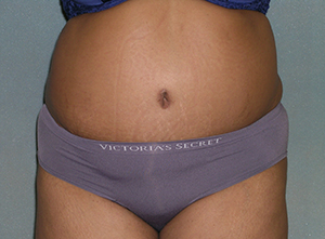 Tummy Tuck Before and After Photos