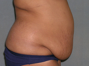 Tummy Tuck Before and After Photos